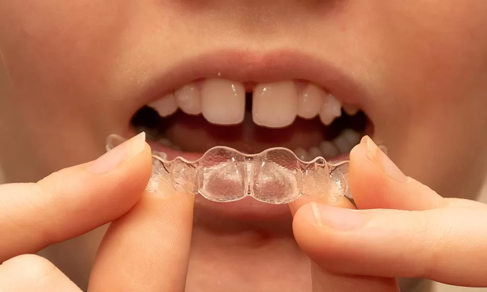 Love About Invisalign Teen